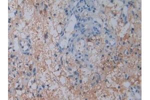 Detection of CD26 in Human Glioma Tissue using Polyclonal Antibody to Cluster Of Differentiation 26 (CD26)