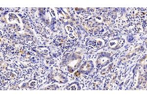 Detection of GCSFR in Human Stomach cancer Tissue using Polyclonal Antibody to Colony Stimulating Factor Receptor, Granulocyte (GCSFR)