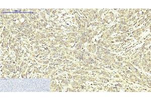 Immunohistochemistry of paraffin-embedded Human breast cancer tissue using ABCB5 Monoclonal Antibody at dilution of 1:200.