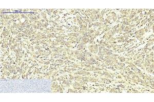 Immunohistochemistry of paraffin-embedded Human breast cancer tissue using ABCB5 Monoclonal Antibody at dilution of 1:200. (ABCB5 anticorps)