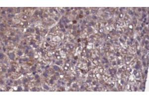 ABIN6276823 at 1/100 staining Human liver cancer tissue by IHC-P.