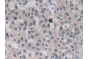 Detection of MTHFR in Human Lung cancer Tissue using Polyclonal Antibody to Methylenetetrahydrofolate Reductase (MTHFR)