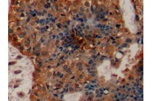 Detection of EGFR in Human Breast cancer Tissue using Polyclonal Antibody to Epidermal Growth Factor Receptor (EGFR)