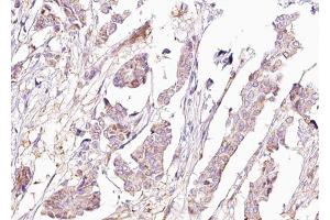 ABIN6267680 at 1/100 staining human Breast carcinoma tissue sections by IHC-P. (BAD anticorps  (pSer155))