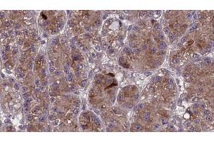 ABIN6273984 at 1/100 staining Human liver cancer tissue by IHC-P. (OR2V1 anticorps  (Internal Region))