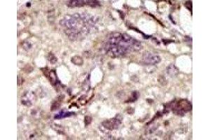 IHC analysis of FFPE human breast carcinoma tissue stained with the BTK antibody (BTK anticorps  (AA 209-239))