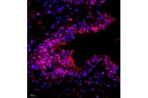 Immunofluorescence of paraffin embedded human breast cancer using SUV39H1 (ABIN7075770) at dilution of 1:1000 (400x lens) (SUV39H1 anticorps)