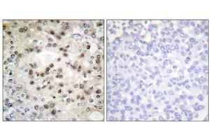 Immunohistochemistry analysis of paraffin-embedded human breast carcinoma tissue using USF2 antibody. (USF2 anticorps  (Internal Region))