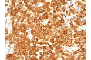 IHC staining of human melanoma with gp100 antibody (HMB45). (Melanoma gp100 anticorps)