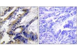 Immunohistochemistry analysis of paraffin-embedded human colon carcinoma tissue, using ILKAP Antibody. (ILKAP anticorps  (AA 41-90))