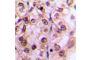 Immunohistochemical analysis of MST1/2 (pT183) staining in human breast cancer formalin fixed paraffin embedded tissue section. (MST1/MST2 (pSer183) anticorps)