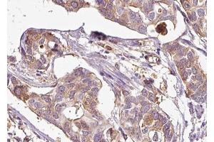 ABIN6267685 at 1/100 staining human Breast cancer tissue sections by IHC-P.