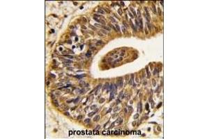 Formalin-fixed and paraffin-embedded human prostata carcinoma tissue reacted with ERBB2 Antibody (C-term ), which was peroxidase-conjugated to the secondary antibody, followed by DAB staining.