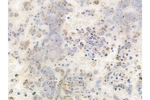 ABIN6256779 and ABIN6267619 at 1/100 staining human melanoma by IHC-P. (PKC delta anticorps  (pTyr64))