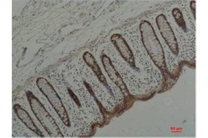 Immunohistochemistry (IHC) analysis of paraffin-embedded Human Colon Carcicnoma using HSP90 alpha Mouse Monoclonal Antibody diluted at 1:200. (HSP90AA2 anticorps)