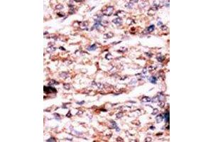 Formalin-fixed and paraffin-embedded human cancer tissue reacted with the primary antibody, which was peroxidase-conjugated to the secondary antibody, followed by AEC staining. (PSKH1 anticorps  (N-Term))