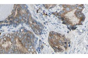 ABIN6269165 at 1/100 staining Human prostate tissue by IHC-P. (Phospholipase C gamma 2 anticorps  (Internal Region))