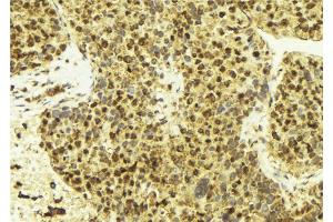 ABIN6269080 at 1/100 staining Human breast cancer tissue by IHC-P. (Estrogen Receptor alpha anticorps  (C-Term))