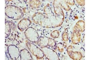 Immunohistochemistry of paraffin-embedded human gastric cancer using ABIN7155429 at dilution of 1: 100 (HIST2H3A anticorps  (AA 108-136))