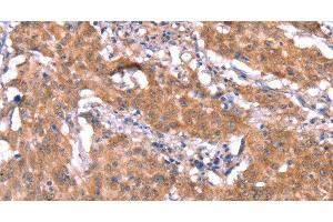 Immunohistochemistry of paraffin-embedded Human gastric cancer tissue using FAM13B Polyclonal Antibody at dilution 1:30 (FAM13B anticorps)