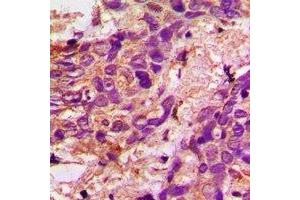 Immunohistochemical analysis of Aconitase 1 staining in human prostate cancer formalin fixed paraffin embedded tissue section.