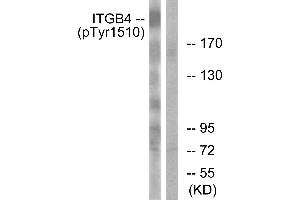 Immunohistochemistry analysis of paraffin-embedded human breast carcinoma tissue using ITGB4 (Phospho-Tyr1510) antibody. (Integrin beta 4 anticorps  (pTyr1510))