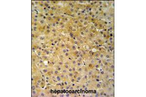 NDUFA10 Antibody IHC analysis in formalin fixed and paraffin embedded hepatocarcinoma followed by peroxidase conjugation of the secondary antibody and DAB staining. (NDUFA10 anticorps  (AA 252-281))