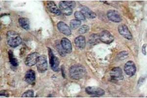 Immunohistochemistry (IHC) analyzes of p-c-Src antibody in paraffin-embedded human breast carcinoma tissue.