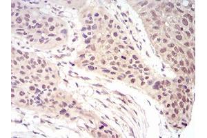 Immunohistochemical analysis of paraffin-embedded esophageal cancer tissues using EIF5A mouse mAb with DAB staining.