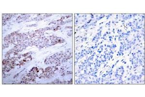 Immunohistochemical analysis of paraffin-embedded human breast carcinoma tissue using ATF4(Phospho-Ser245) Antibody(left) or the same antibody preincubated with blocking peptide(right). (ATF4 anticorps  (pSer245))