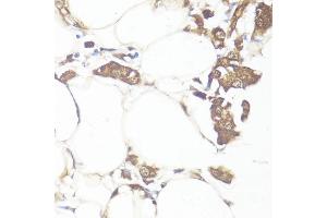 Immunohistochemistry of paraffin-embedded human breast cancer using Smad7 antibody (ABIN7270356) at dilution of 1:100 (40x lens). (SMAD7 anticorps  (AA 1-100))