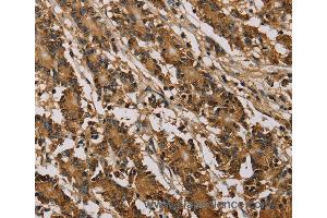 Immunohistochemistry of Human colon cancer using PSMC2 Polyclonal Antibody at dilution of 1:30 (PSMC2 anticorps)