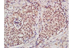 Formalin-fixed and paraffin embedded human laryngeal carcinoma  labeled with Rabbit Anti-PCNA [Proliferation Marker] Polyclonal Antibody (ABIN676598) at 1:200 followed by conjugation to the secondary antibody and DAB staining (PCNA anticorps  (AA 201-261))