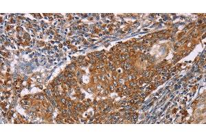 Immunohistochemistry of paraffin-embedded Human cervical cancer tissue using PMPCB Polyclonal Antibody at dilution 1:50 (PMPCB anticorps)