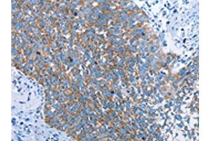 The image on the left is immunohistochemistry of paraffin-embedded Human cervical cancer tissue using ABIN7129698(HINT2 Antibody) at dilution 1/40, on the right is treated with fusion protein. (HINT2 anticorps)