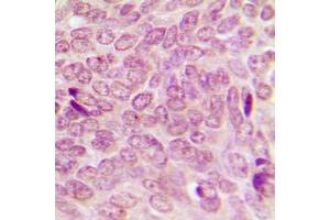 Immunohistochemical analysis of SUMO1 staining in human breast cancer formalin fixed paraffin embedded tissue section.