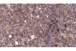 ABIN6276788 at 1/100 staining Human liver cancer tissue by IHC-P. (ITGAL anticorps  (N-Term))