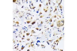 Immunohistochemistry of paraffin-embedded human lung cancer using EP300 antibody (ABIN6127823, ABIN6140193, ABIN6140194 and ABIN6216844) at dilution of 1:100 (40x lens). (p300 anticorps  (AA 1-270))