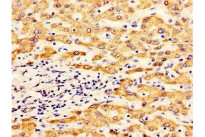 IHC image of ABIN7170921 diluted at 1:400 and staining in paraffin-embedded human liver cancer performed on a Leica BondTM system. (ALDH5A1 anticorps  (AA 48-535))