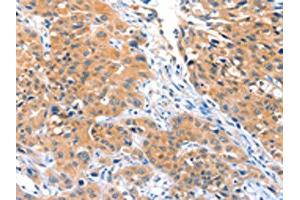 The image on the left is immunohistochemistry of paraffin-embedded Human lung cancer tissue using ABIN7128174(ACOX3 Antibody) at dilution 1/25, on the right is treated with fusion protein. (ACOX3 anticorps)