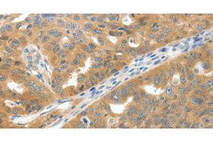 Immunohistochemistry of paraffin-embedded Human ovarian cancer tissue using SCN9A Polyclonal Antibody at dilution 1:40