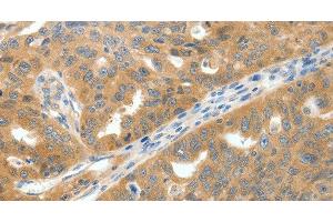 Immunohistochemistry of paraffin-embedded Human ovarian cancer tissue using SCN9A Polyclonal Antibody at dilution 1:40 (SCN9A anticorps)