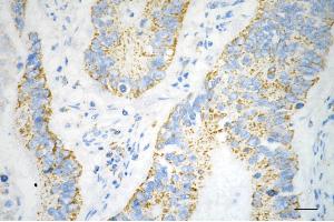 Immunohistochemistry was performed on paraffin-embedded human sigmoid colon carcinoma using COX IV antibody (ABIN7798247), 1:200).