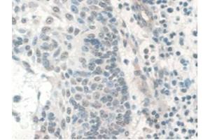 IHC-P analysis of Human Skin Cancer Tissue, with DAB staining. (COQ6 anticorps  (AA 1-468))