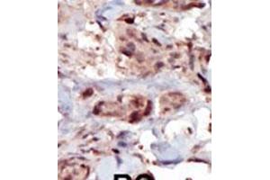 Formalin-fixed and paraffin-embedded human cancer tissue reacted with the primary antibody, which was peroxidase-conjugated to the secondary antibody, followed by AEC staining.