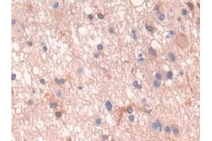 DAB staining on IHC-P; Samples: Human Glioma Tissue