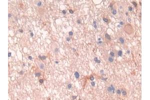 DAB staining on IHC-P; Samples: Human Glioma Tissue (PTH1R anticorps  (AA 28-188))