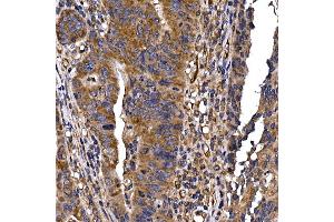 Immunohistochemistry of paraffin-embedded human colon carcinoma using DYNC1LI2 Rabbit pAb (ABIN7266863) at dilution of 1:25 (40x lens).