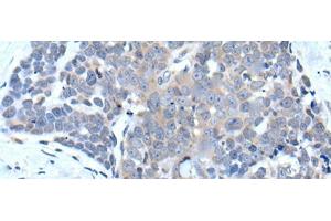 Immunohistochemistry of paraffin-embedded Human thyroid cancer tissue using VPS35 Polyclonal Antibody at dilution of 1:25(x200)