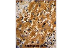 Formalin-fixed and paraffin-embedded human hepatocarcinoma with CASP9 Antibody , which was peroxidase-conjugated to the secondary antibody, followed by DAB staining.